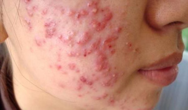 Mụn bọc là gì?