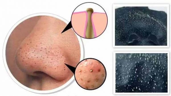 Mụn đầu đen, đầu trắng