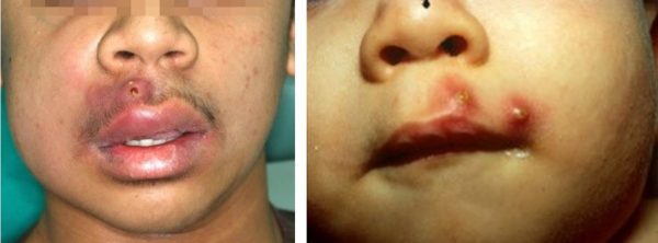 Mụn đinh râu là gì? Nguyên nhân gây mụn đinh râu