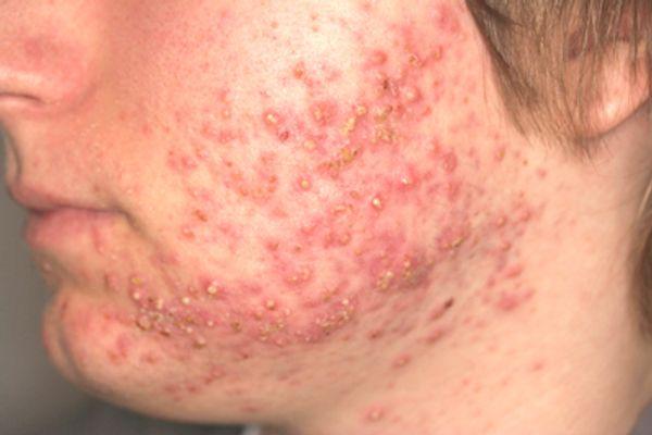 Mụn trứng cá – Loại mụn thường gặp phổ biến nhất