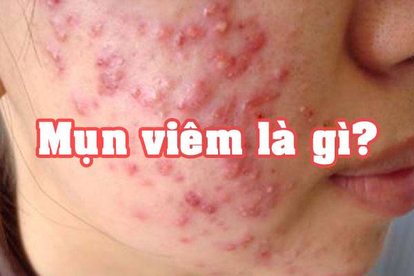 Mụn viêm là gì? Và những cách điều trị mụn phù hợp, hiệu quả