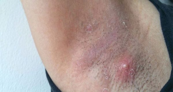 Nổi mụn ở nách là bệnh gì – Cách khắc phục đơn giản tại nhà