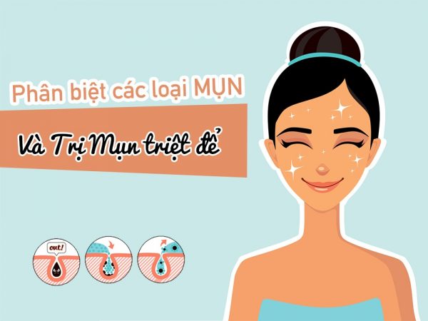 Phân biệt các loại mụn thường gặp [Kèm nguyên nhân, cách điều trị]