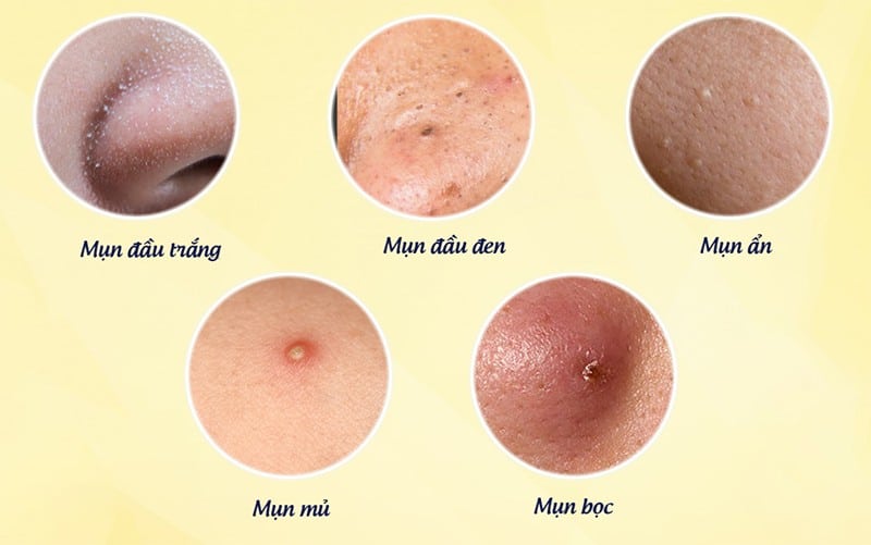 Các loại mụn thường gặp