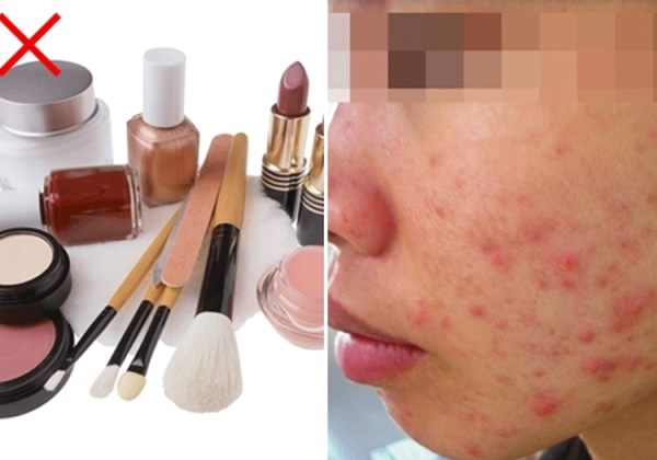 Do sử dụng mỹ phẩm, bôi các chất không hợp da