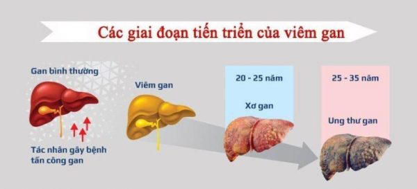 Phân biệt viêm gan B cấp tính và viêm gan B mạn tính