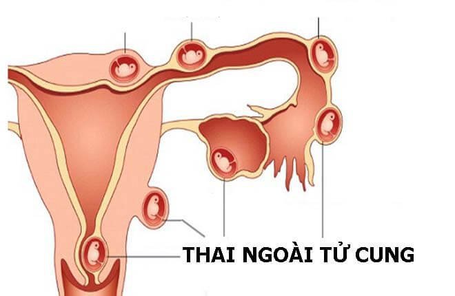 thai ngoài tử cung siêu âm có thấy không