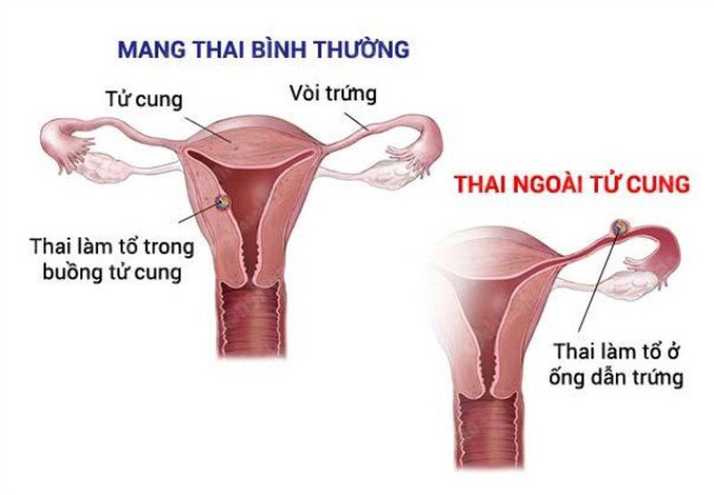 Thai Ngoài Tử Cung Bao Lâu Thì đau Bụng Biến Chứng Nguy Hiểm 