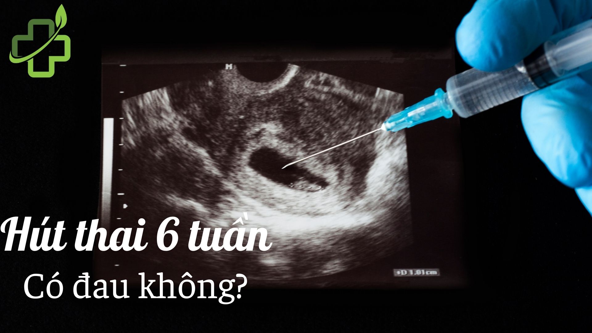 Hút thai 6 tuần tuổi có đau không – Giải đáp từ chuyên gia