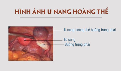 nang hoàng thể là gì