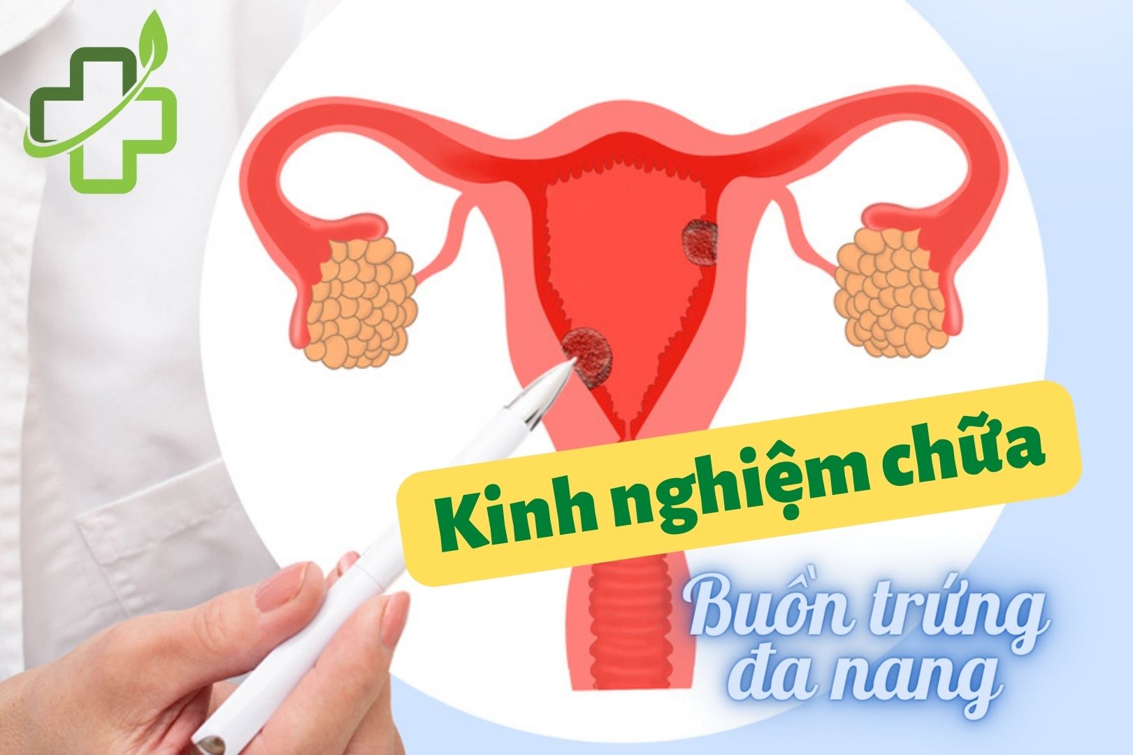 kinh nghiệm chữa buồng trứng đa năng