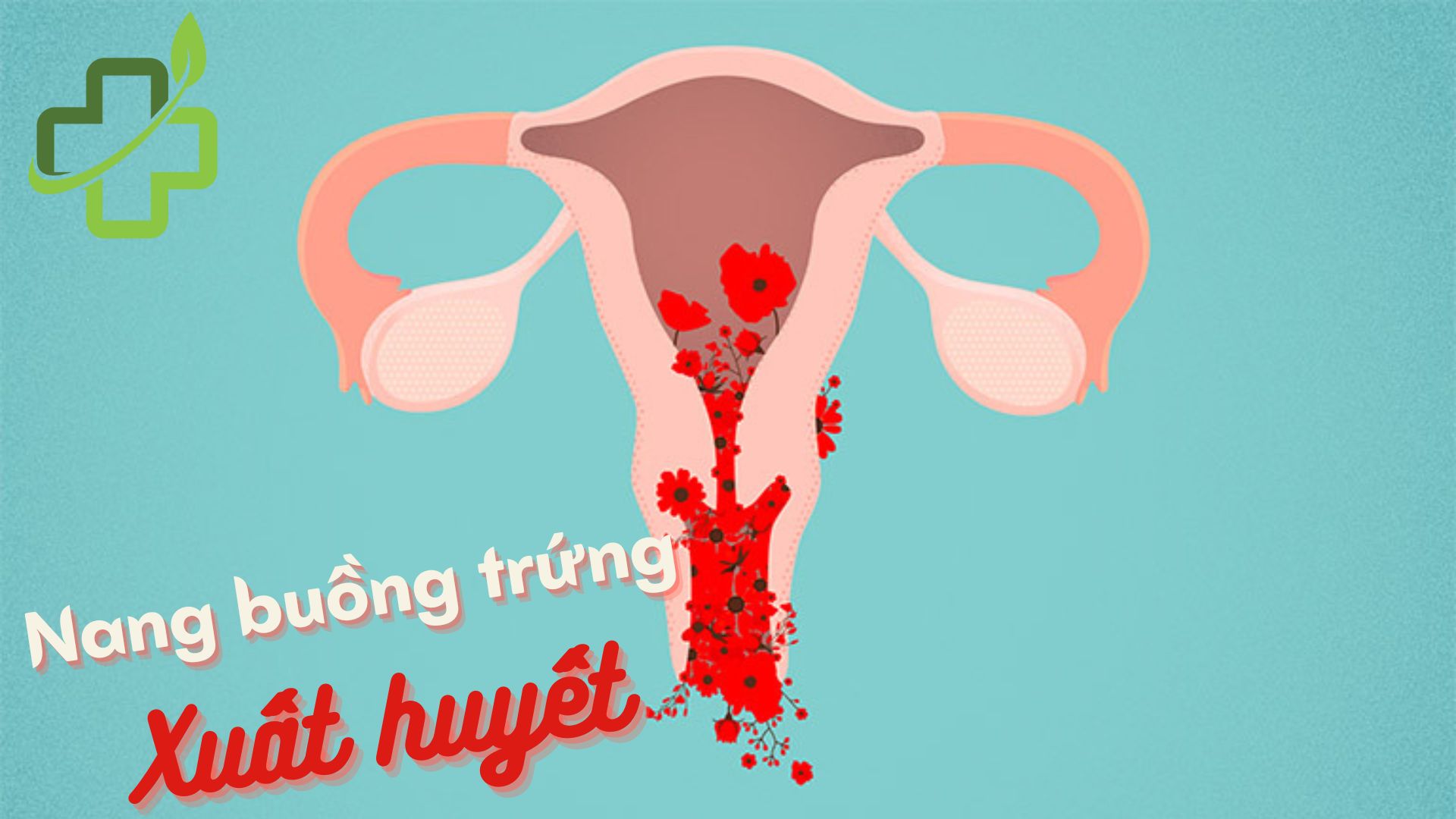 nang buồng trứng xuất huyết