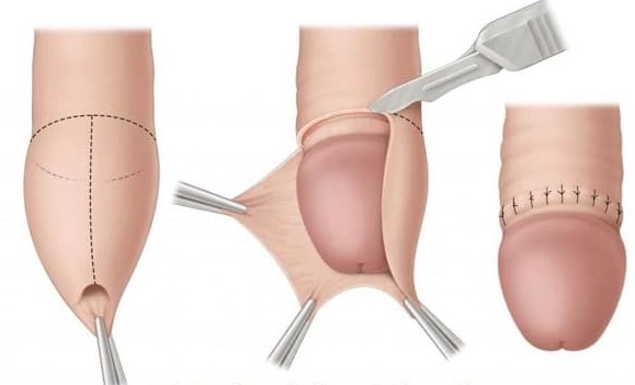 cận cảnh cắt bao quy đầu