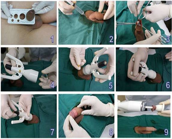 công nghệ cắt bao quy đầu hiện đại nhất