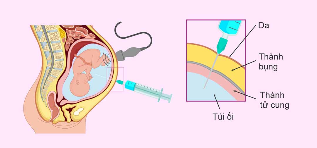 Nắm rõ mang thai trai hay gái nhờ phương pháp chọc ối