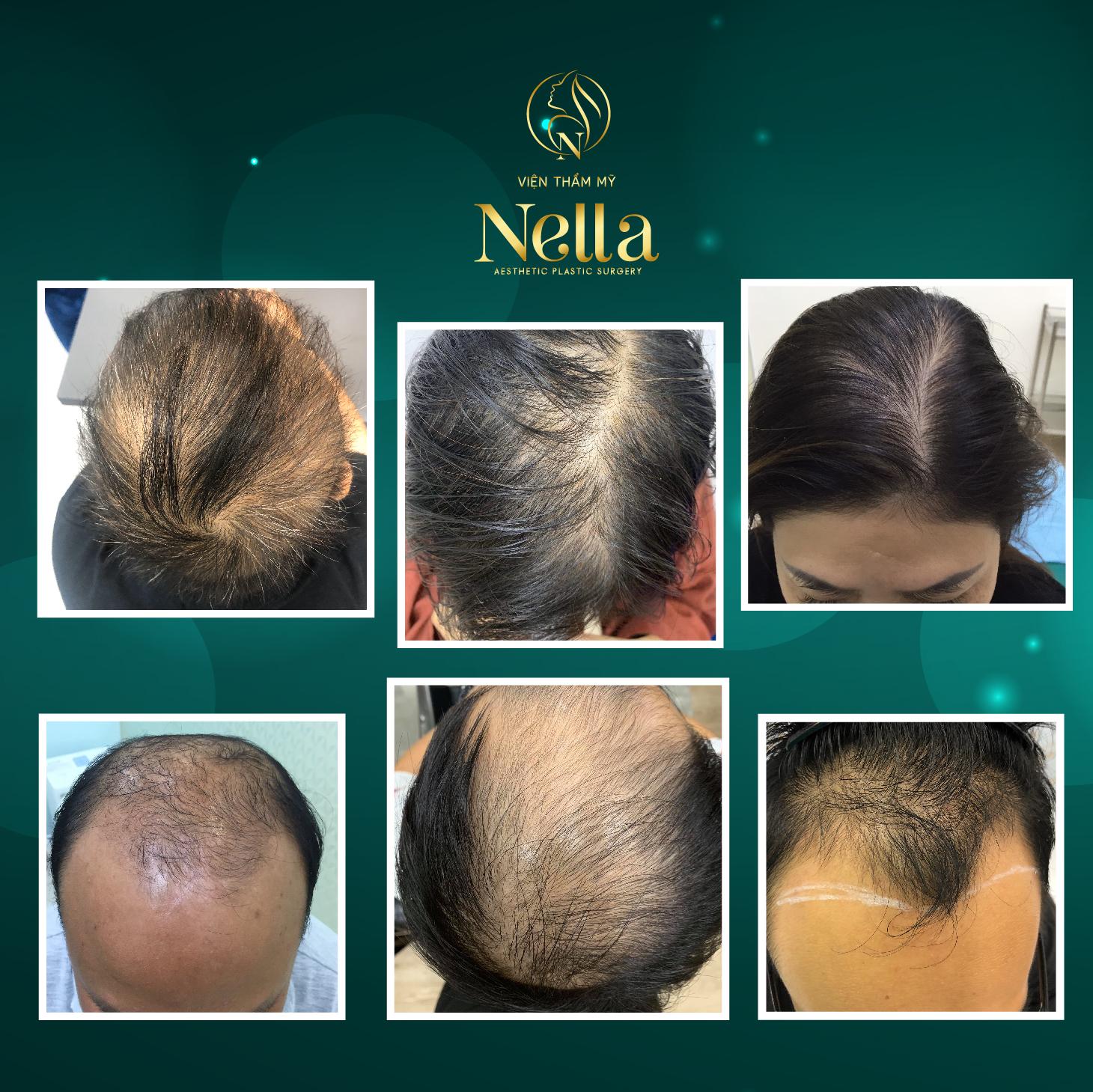 Viện cấy tóc Nella – Địa chỉ cấy tóc TpHCM nhiều người lựa chọn