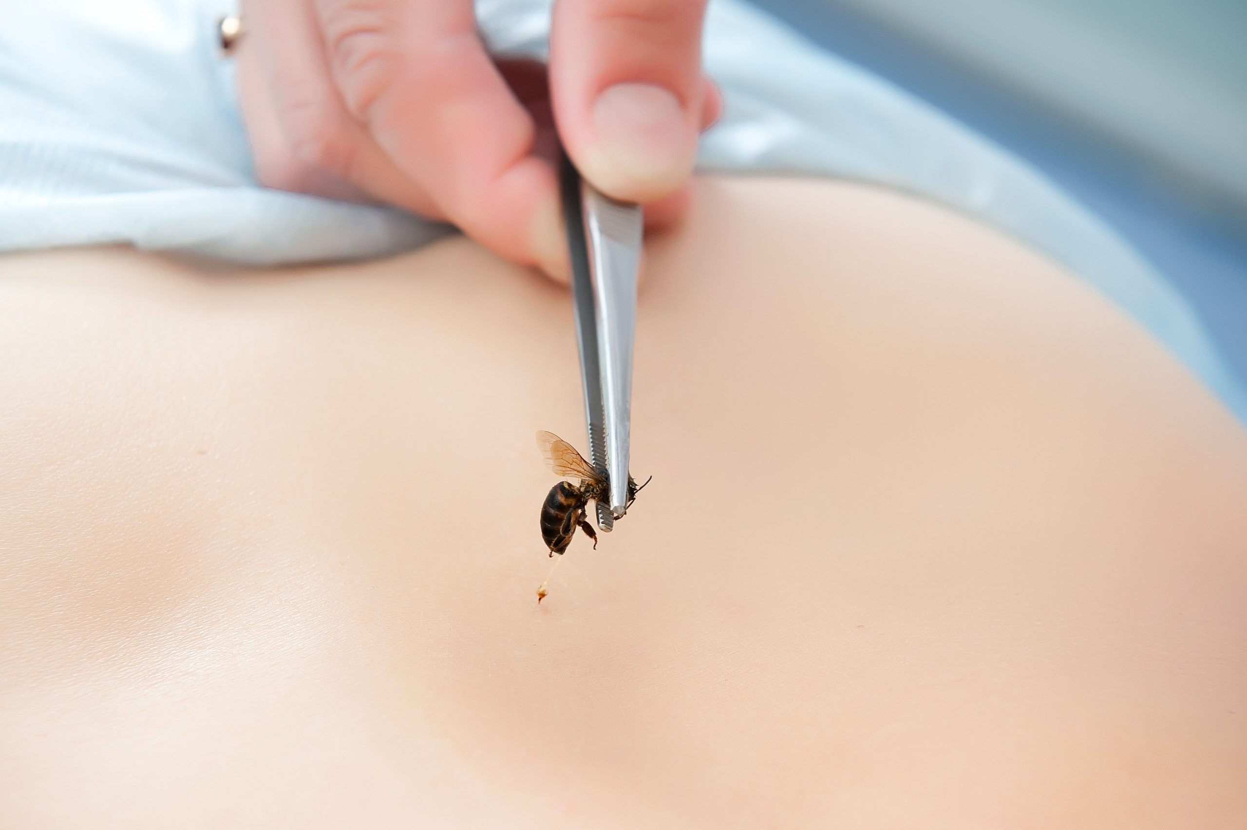 Có bầu bị ong đốt có sao không – Một số cách phòng tránh bị ong đốt
