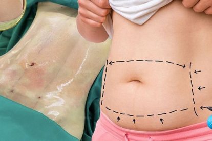 Giá hút mỡ bụng ở bệnh viện 108 bao nhiêu? Có đắt không?